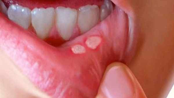 Perbedaan antara Sariawan Biasa dengan Herpes pada Mulut